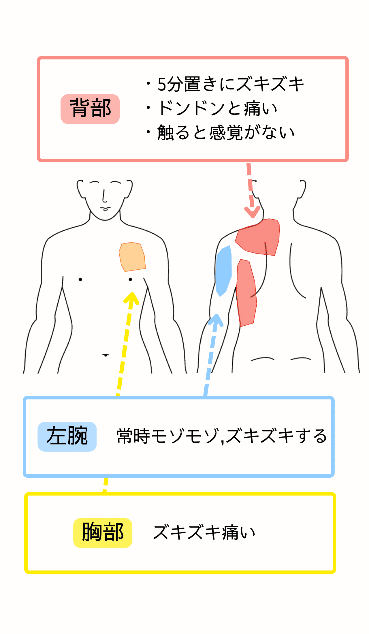 帯状疱疹後神経痛 | 名古屋市緑区 いたみとしびれ千寿堂